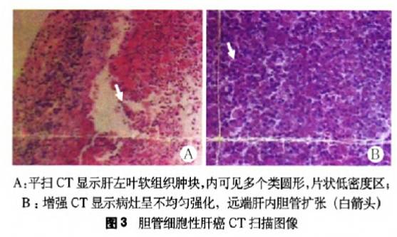患者反复腹胀，嗜酸性粒细胞升高，提示什么疾病？