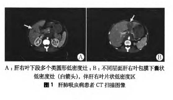 嗜酸性粒细胞增高伴反复腹胀的治疗方案