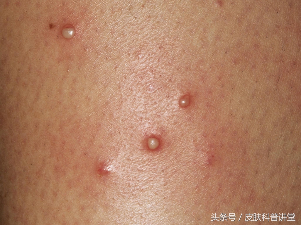 毛囊炎图片 颗粒状小疙瘩图片-始兴思宇科技
