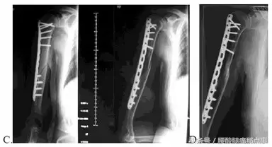 从木匠到骨科医师——浅谈骨折固定理念的更新和发展