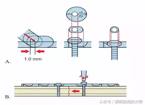 从木匠到骨科医师——浅谈骨折固定理念的更新和发展