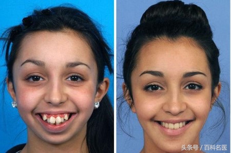 以下4种牙齿畸形可通过矫正来改变脸型，整牙相当于整容，靠谱！