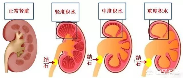 得了输尿管结石不用怕，疼痛不要忍，这样治疗就可以啦！