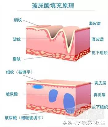 微整形有三宝，您知道是什么吗？