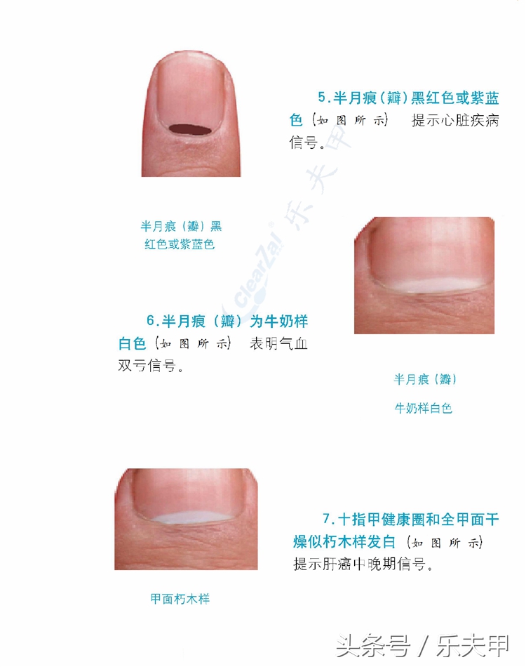 教你从指甲外形判断自己的健康，不同形状状预示不同的疾病