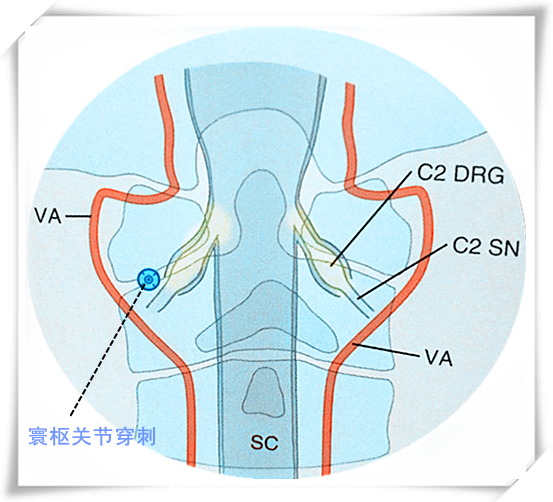 疼痛科：睡了等于没睡、越睡越累、醒后头痛头胀脖子痛，颈椎病？