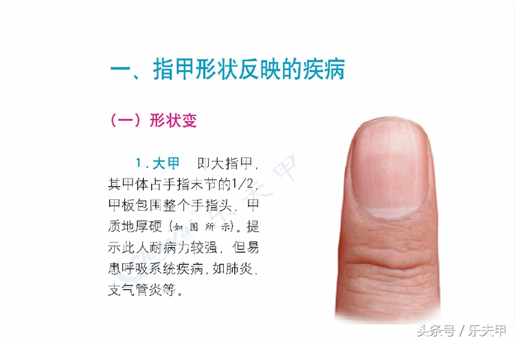 教你从指甲外形判断自己的健康，不同形状状预示不同的疾病