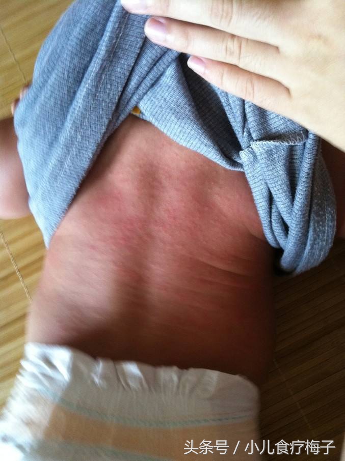 婴儿股沟湿疹图片(宝宝长的是痱子还是湿疹) - 乐宝宝贝