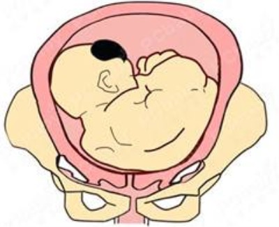 ROA胎儿姿势图片