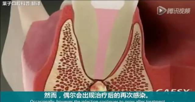 牙龈起脓包，你就只知道吃消炎药？那么脓包下次还会来
