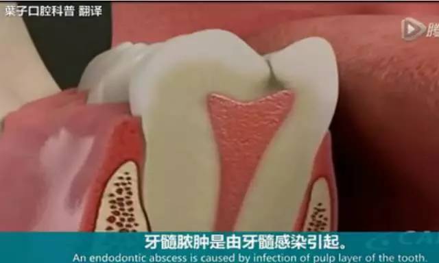 牙龈脓包处理方法：如何有效消除牙龈肿胀和感染