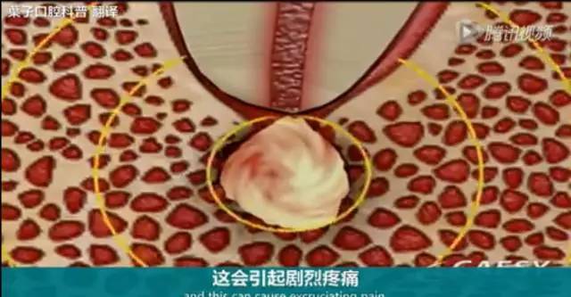 牙龈起脓包，你就只知道吃消炎药？那么脓包下次还会来