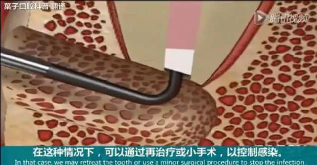 牙龈起脓包，你就只知道吃消炎药？那么脓包下次还会来
