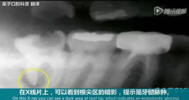 牙龈起脓包，你就只知道吃消炎药？那么脓包下次还会来