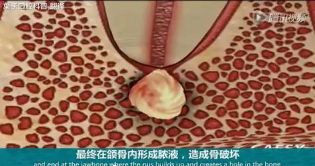 牙龈起脓包，你就只知道吃消炎药？那么脓包下次还会来