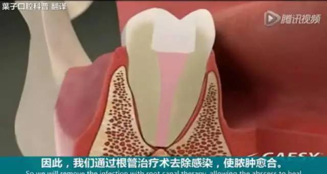 牙龈起脓包，你就只知道吃消炎药？那么脓包下次还会来