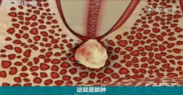 牙龈起脓包，你就只知道吃消炎药？那么脓包下次还会来