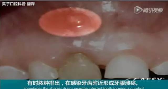 牙龈起脓包，你就只知道吃消炎药？那么脓包下次还会来