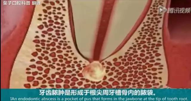 牙龈起脓包，你就只知道吃消炎药？那么脓包下次还会来