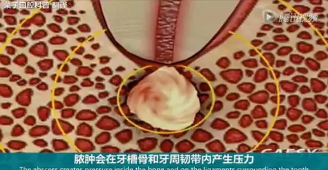 牙龈起脓包，你就只知道吃消炎药？那么脓包下次还会来