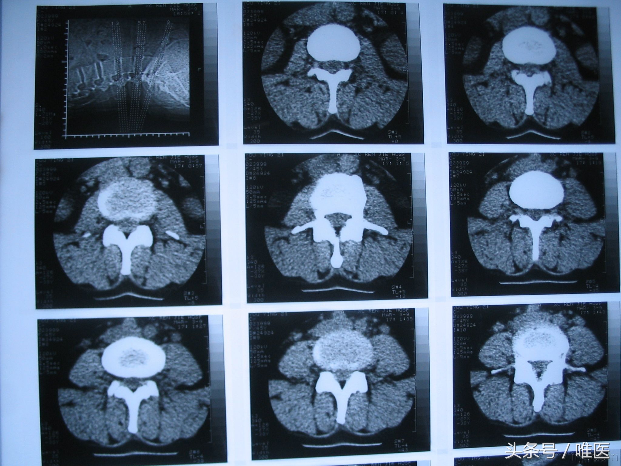 腰椎拍了X光片，为什么还要做腰椎CT或核磁共振（MRI）