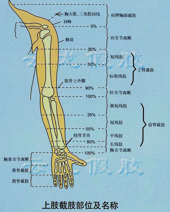 截肢患者选择假肢的注意事项