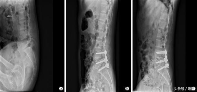 腰椎拍了X光片，为什么还要做腰椎CT或核磁共振（MRI）