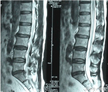 腰椎拍了X光片，为什么还要做腰椎CT或核磁共振（MRI）