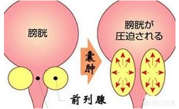 体检发现前列腺囊肿，有什么危害，能自愈？需要手术治疗？