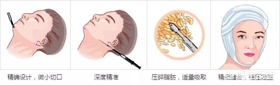 谁说你脸方是天生的？可能只是咬肌太大！4个动作帮你轻松瘦脸