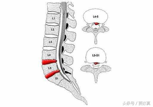 腰椎间盘突出不要忽视腰疼，别等出现下肢症状再重视！
