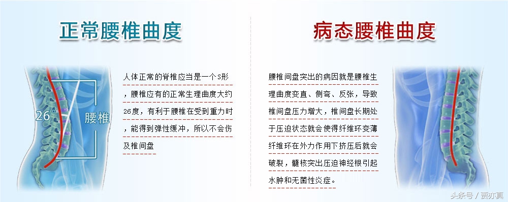 腰椎间盘突出不要忽视腰疼，别等出现下肢症状再重视！