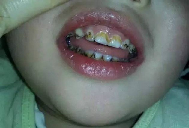 儿童牙齿小黑点图片(孩子满口黑牙就像50岁的) - 赤虎壹号