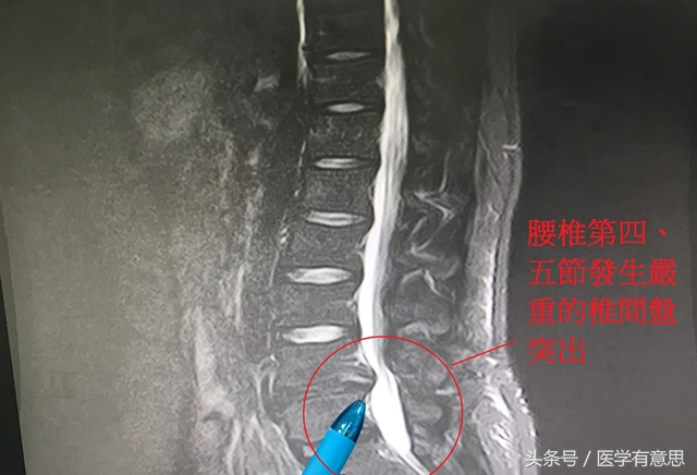 闪腰不是小问题，拖久了可能会瘫痪，一定要警惕