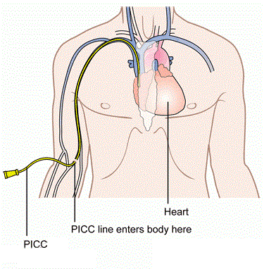 静脉输液英文缩写(什么是PICC？为什么癌症病人要做PICC?)