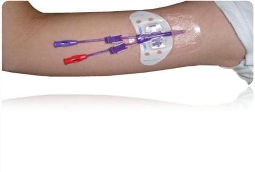 picc是什么意思 pivc是什么导管的缩写 - 大百科