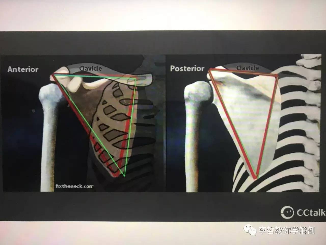 学员精彩笔记（23）——超级全面而仔细的肩胛骨评估教程