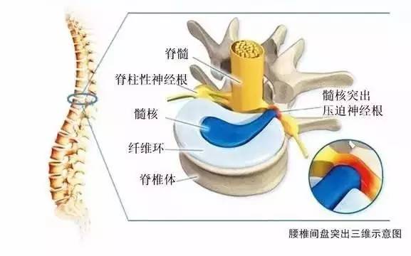 湖北婆婆腰腿疼痛不在意，8年后一查竟是得了这个病！有这些症状都要当心~