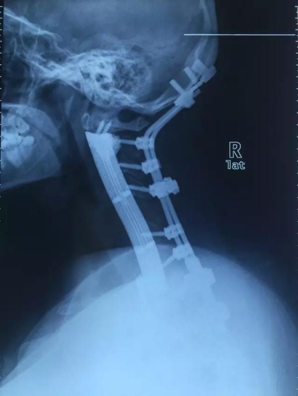 世界首例：长征医院用3D打印将患者全颈椎椎体换为钛合金