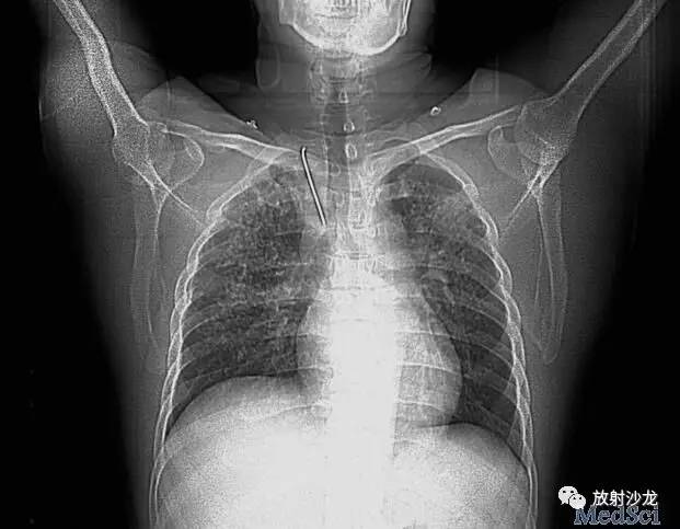 锁骨内固定钢钉脱落损伤主动脉 后果很严重