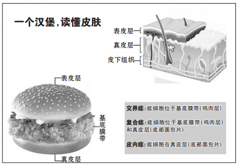 排查身上痣：哪种可以点，哪种易恶变