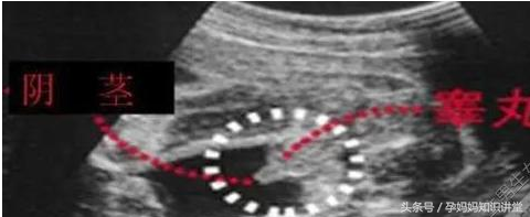 生男生女不求人，读懂B超单验证胎儿是男是女