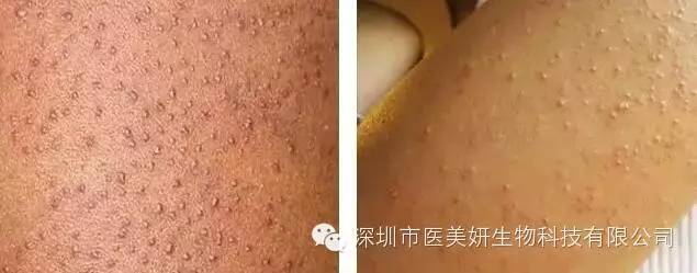 史上最全色斑诊断方法！你脸上有几种？（朋友圈都传疯了）