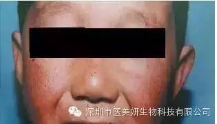 史上最全色斑诊断方法！你脸上有几种？（朋友圈都传疯了）