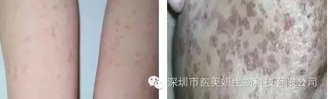 史上最全色斑诊断方法！你脸上有几种？（朋友圈都传疯了）