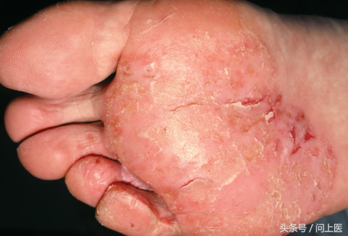 引起癣的真菌也可能会引起足癣,而且其经常出现在脚底和脚趾之间,这些