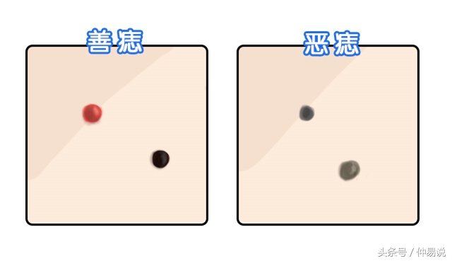 嘴角恶痣注意是非,鼻梁恶痣需晚婚!