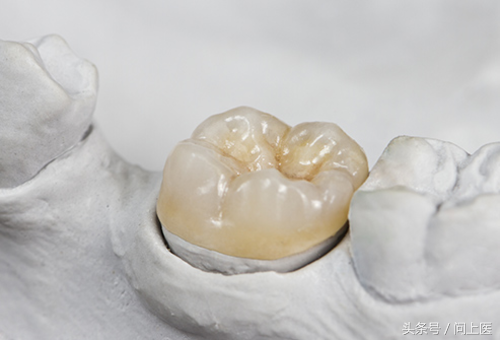 4 / 13 嵌体(嵌齿)/高嵌体