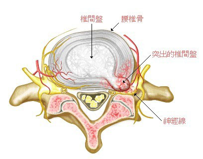 医院建议你做腰椎间盘突出症手术，你要懂这些，将不会终生后悔！