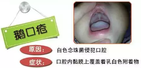 4种突袭的口腔疾病，个个影响娃的食欲！赶快治！